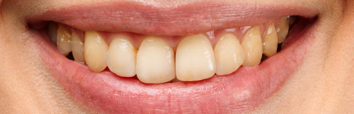 Imagen dental antes del tratamiento